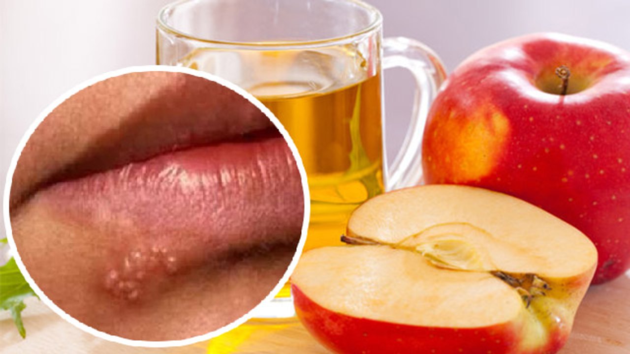 होंठो पर सफेद दानों का घरेलू इलाज । Hotho Par Safed Dano Ka Gharelu Ilaj। Boldsky *Health