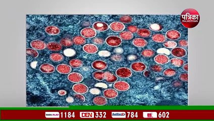 मंकीपॉक्स (Monkeypox) पीड़ित की सड़ गयी नाक, फिर हुआ ...