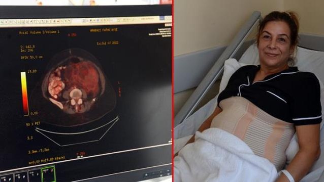 Şişkinlik şikayetiyle hastaneye gitti, karnından 10 kiloluk kanserli kitle çıkarıldı