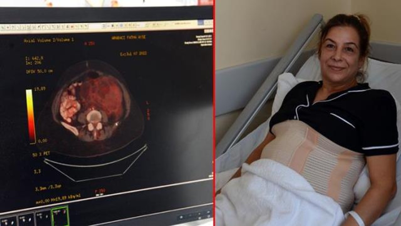 Şişkinlik şikayetiyle hastaneye gitti, karnından 10 kiloluk kanserli kitle çıkarıldı