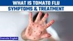 Tomato Flu cases rise to 82 in India | Know all about Tomato Flu | Oneindia News *News