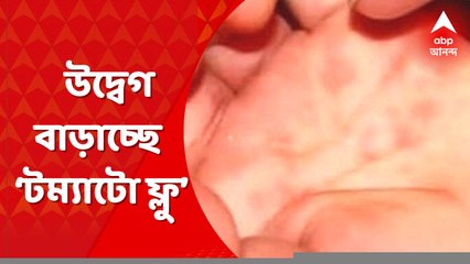 Tomato Flu: ভয় ধরাচ্ছে সোয়াইন ফ্লু এবং ‘টম্যাটো ফ্লু। উপসর্গ দেখা দিলে অবহেলা না করার পরামর্শ দিচ্ছেন চিকিৎসকরা। Bangla News