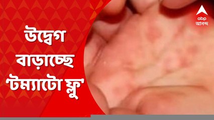 Tomato Flu: মুখ, হাত, গোড়ালি, হাঁটুতে ফোসকা, উদ্বেগ বাড়াচ্ছে ‘টম্যাটো ফ্লু । Bangla News