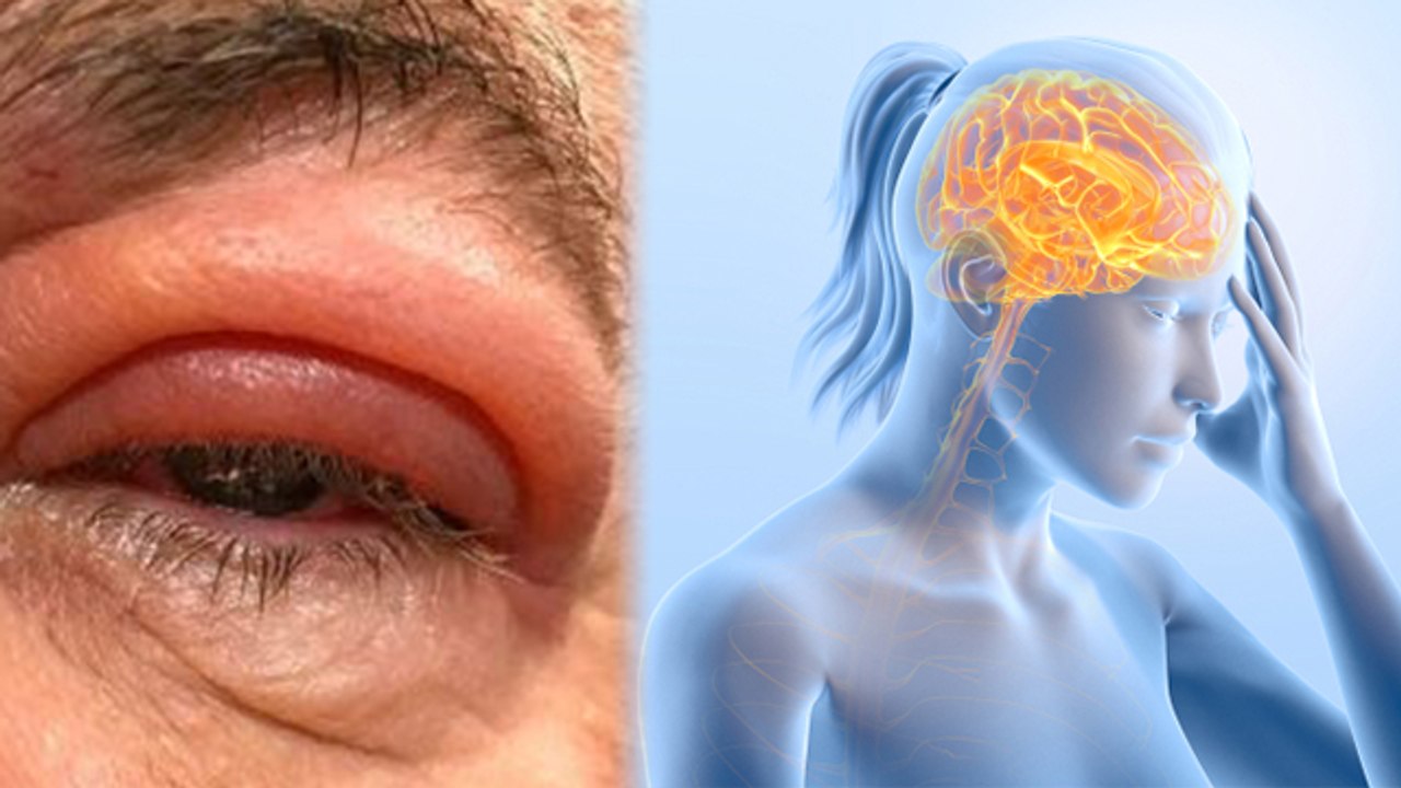 आंख के ऊपर दर्द क्यों होता है । Aankh Ke Upar Dard Kyu Hota hai । Boldsky* Health