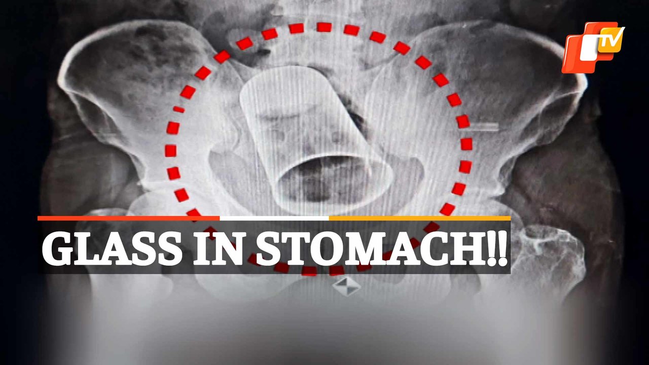 Shocking! Doctors Remove Steel Glass From Intestine Of Patient In Berhampur