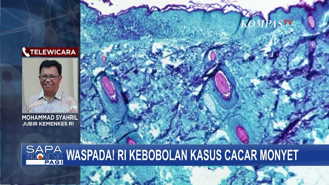 Waspada! Indonesia Kebobolan Kasus Cacar Monyet