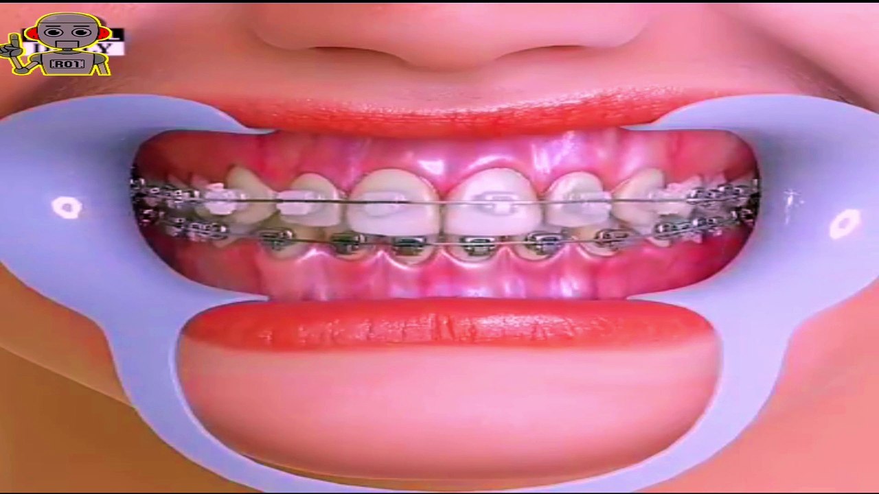THIS IS HOW TO INSTALL GOOD BRACES video Dailymotion