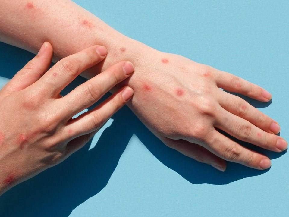 Neues Virus in Indien: So gefährlich ist die 'Tomatengrippe'