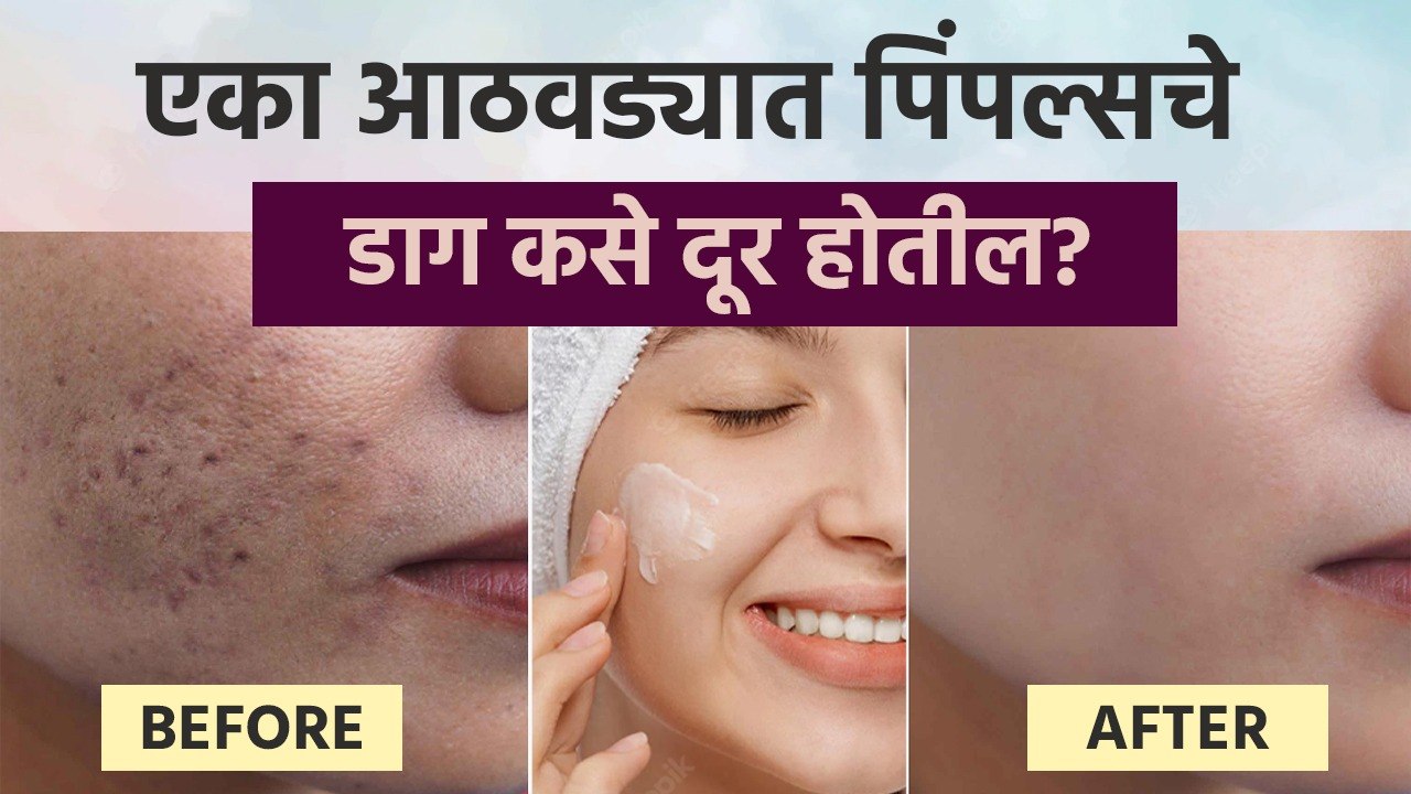एका आठवड्यात पिंपल्सचे डाग कसे दूर होतील? | How...