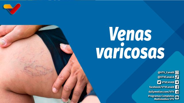 Actitud Saludable | Las venas varicosas causas, síntomas, diagnóstico y tratamiento