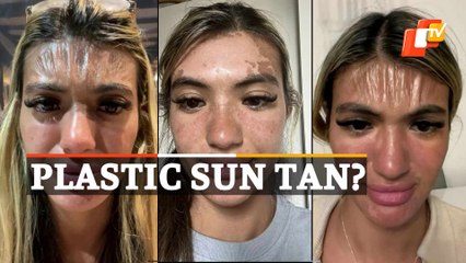 Bizarre! UK Woman Wakes Up With ‘Plastic Forehead’ After Nap Under Sun