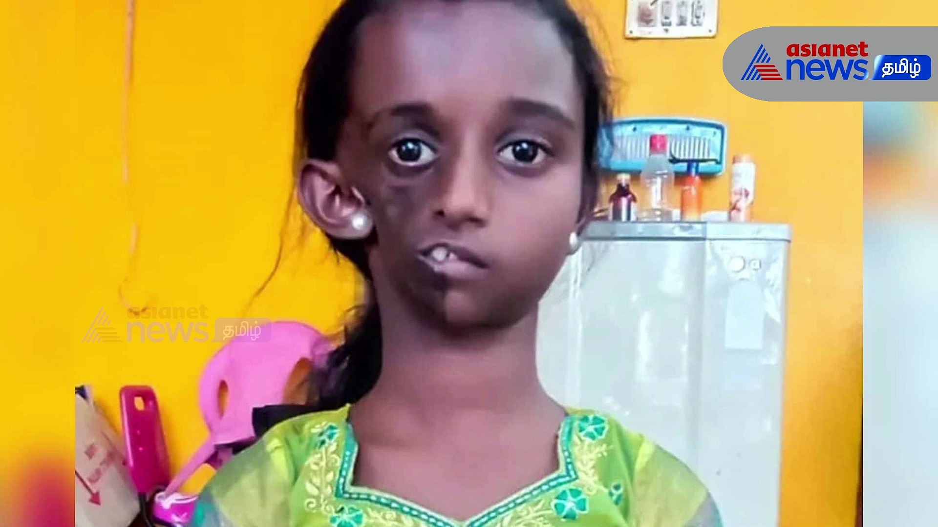 Watch : முகச்சிதைவு நோய் சிறுமிக்கு மேற்கொண்ட அறுவை சிகிச்சை வெற்றி! முதல்வர் ஸ்டாலின் வாழ்த்து!