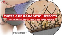 Reason why your Pubic Hair might turn Gray (White Pubic Hair)