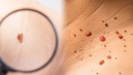 शरीर पर मस्सें बन सकते हैं कैंसर ? | जानें लापरवाही से क्या हो सकती है समस्या | Boldsky *health