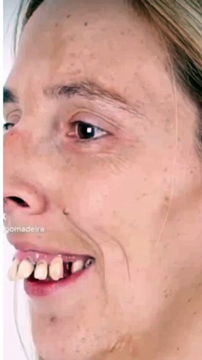 Amazing surgical orthodontics #shorts #viral