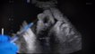 Loi anti-avortement : les Américaines se tournent vers la stérilisation