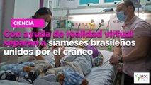Con ayuda de realidad virtual separan a siameses brasileños unidos por el cráneo