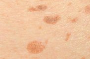 Estudantes de Dermatologia do UNISM alertam sobre manchas que podem ser câncer de pele