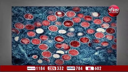 Monkeypox: एक साथ मंकीपॉक्स, कोरोना वायरस और एचआईवी से संक्रमित हुआ और फिर ...