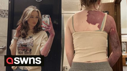 US woman born with purple mark covering her arm says she has "learnt to love herself"