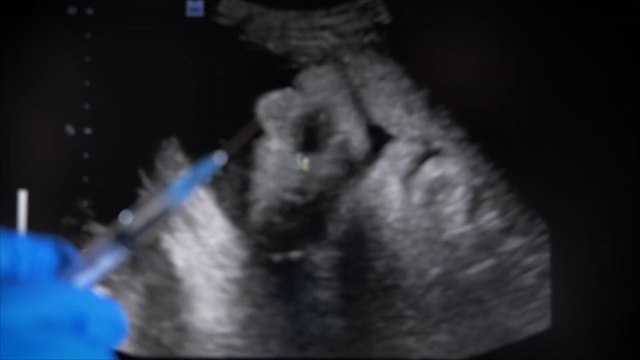 Loi anti-avortement : les Américaines se tournent vers la stérilisation