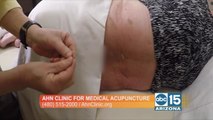 You don't have to live with back pain! Try the Ahn Clinic for Medical Acupuncture