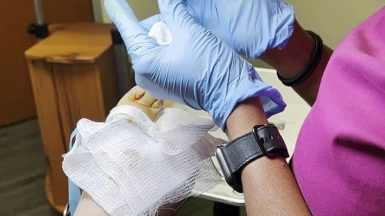 INGROWN TOENAIL REMOVAL