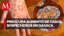 Aumentan caso de viruela símica en Oaxaca