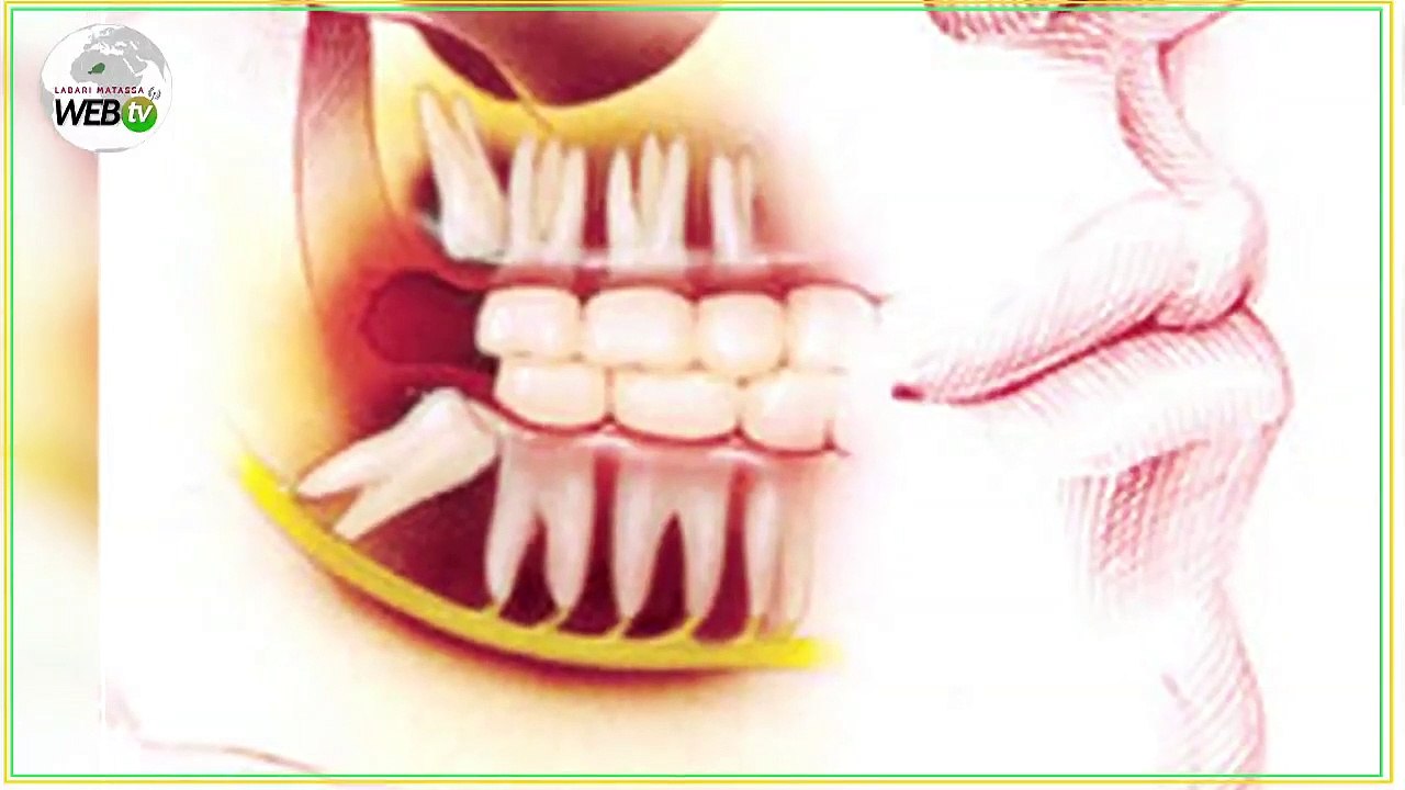 LES DENTS DE SAGESSE