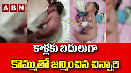 కాళ్లకు బదులుగా కొమ్ముతో జన్మించిన చిన్నారి || ABN Digital