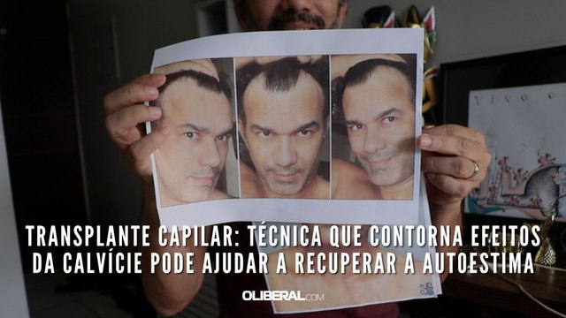 Transplante capilar: técnica que contorna efeitos da calvície pode ajudar a recuperar a autoestima