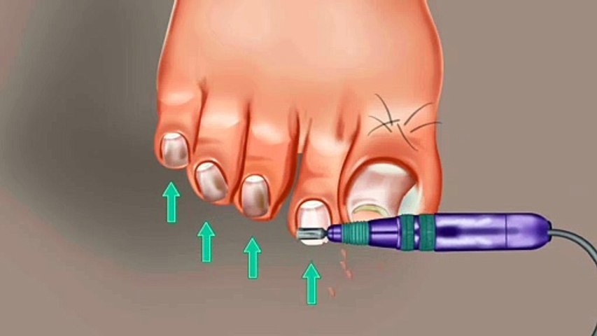 Satisfying ASMR Ingrown toenail removal treatment animation || Gamers Town ASMR