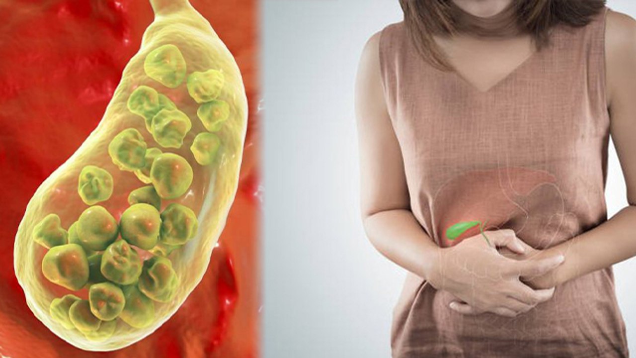 पित्त की पथरी में क्या नहीं खाना चाहिए ? | gallbladder stones में क्या नहीं खाएं | Boldsky *health