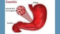 bd-causas-sintomas-y-tratamientos-de-la-gastritis-070922