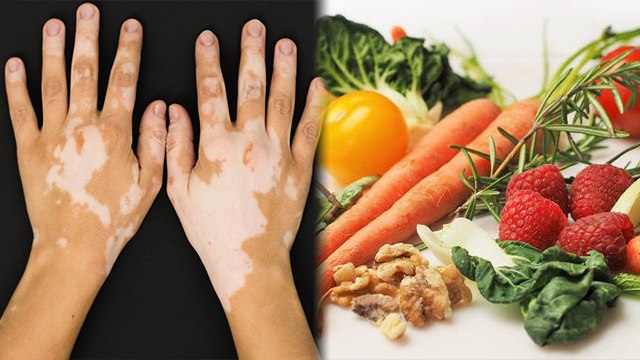 सफ़ेद दाग़ होने पर क्या खाएं क्या नहीं | safed daag me kya khaye kya na khaye | Boldsky *health