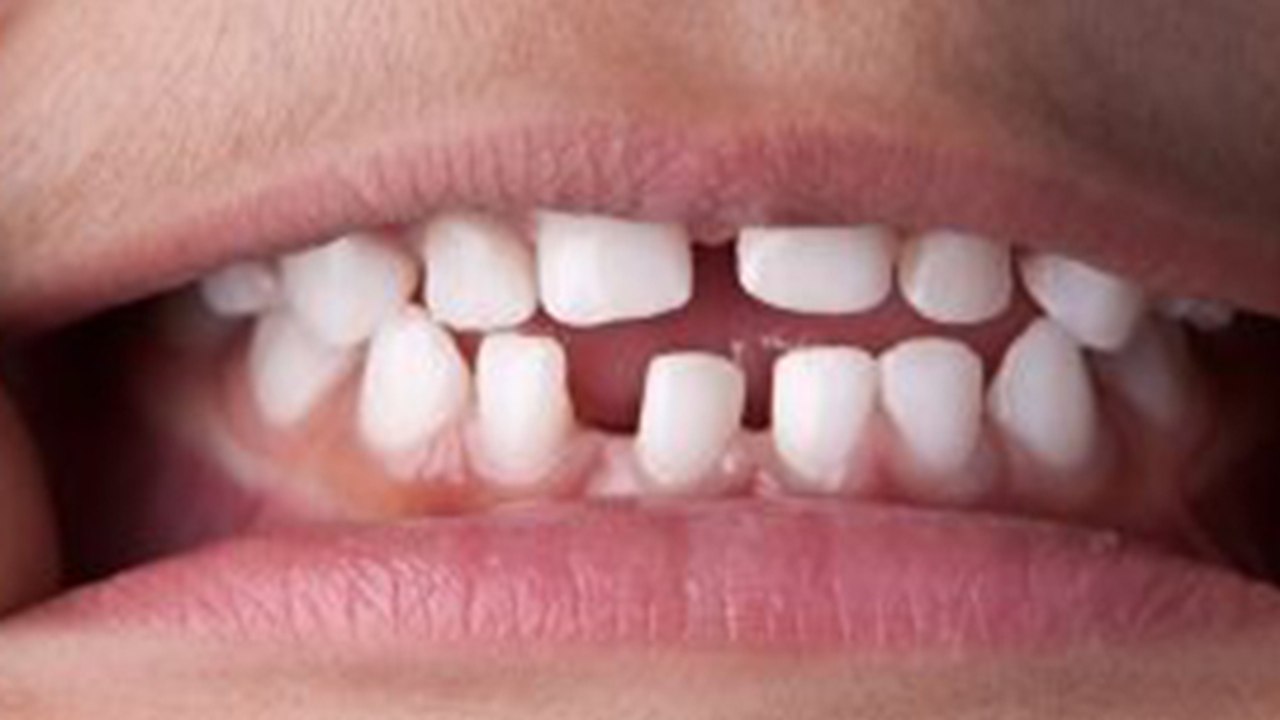 दांतों के बीच गैप दूर करने का जबरदस्त तरीका । Daanto Ke Bich Dur Karne Ka Jabardast Tarika । *Health