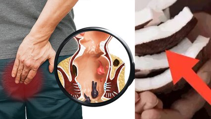 बवासीर को जड़ से खत्म करेगा नारियल का ये नुस्खा । बवासीर में नारियल खाने के फायदे । Boldsky*Health