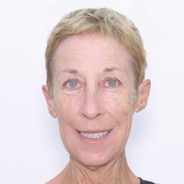 Full Mouth Rehabilitation with Dental Implants