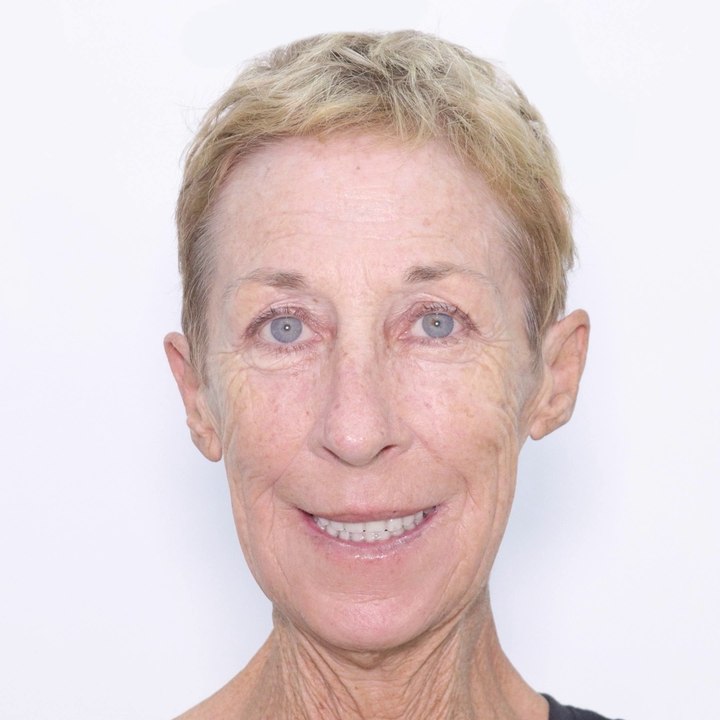 Full Mouth Rehabilitation with Dental Implants