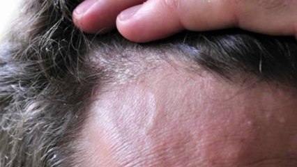 bd-principales-causas-de-la-caspa-y-sus-tratamientos-050922