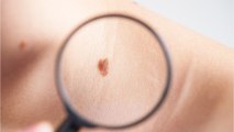 Why do some people get more skin tags than others?