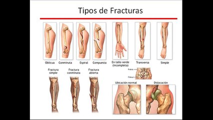 tipos de fractura
