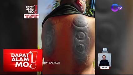 Pagpapa-ventosa, nauwi sa second-degree burn! | Dapat Alam Mo!