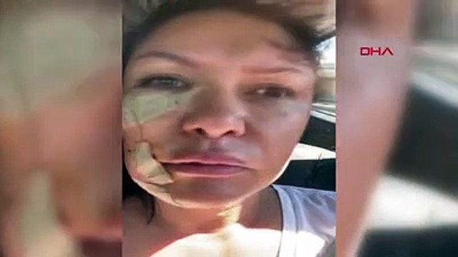 Şarkıcı Tuğba Altıntop kabusu yaşadı! Hastanelik olup, yüzüne dikiş atıldı