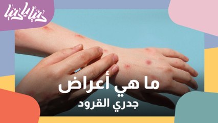 بعد تسجيل أول حالة لجدري القرود في الأردن .. ما هي أبرز أعراض هذا المرض؟