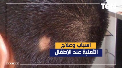الدكتور هاني الناظر يوضح اسباب وعلاج الثعلبة عند الاطفال