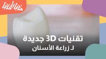 أحدث تقنيات زراعة الأسنان 3D من دون جراحة