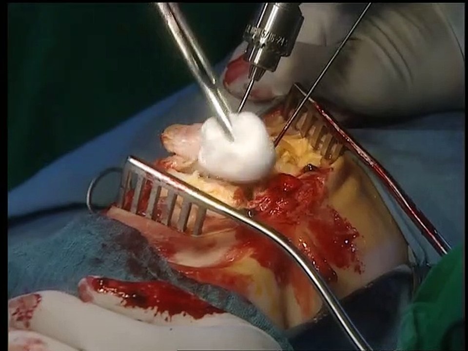 Alphateam - Die Lebensretter im OP Staffel 3 Folge 19 HD Deutsch