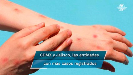 México rebasa los mil casos confirmados de viruela del mono