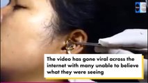 Horrifying Moment Surgeon Struggles to Remove Live Snake from Woman’s Ear in Viral Bizarre Video
